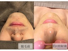 メンズアルファ/【髭】光脱毛before after 30代