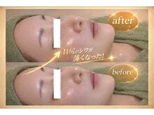 ココホワイトニング(coco whitening)の雰囲気(つくばでは珍しいTIPバーブピーリング《シワ》《毛穴》《乾燥》)