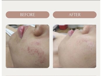 マオ(mao)/☆5回Before→after☆