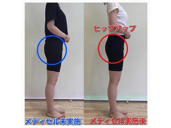 スリーエー(AAA)/筋膜リリース