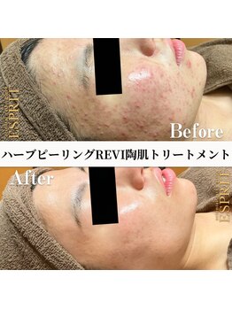 エスプリ 銀座店/ハーブピーリング銀座