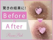 ローマピンクの施術後の注意事項