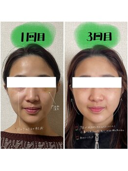 ストック(Stock)/美容鍼の変化