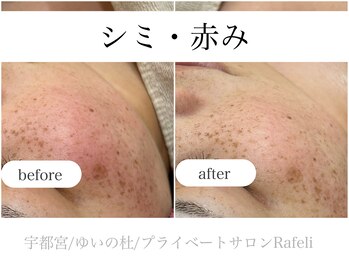 ラフェリ(Rafeli)/シミ改善・赤み改善