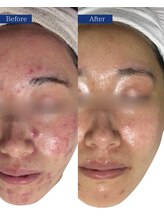 ビズビズ(bisebise)/メンズニキビ学割U24★大阪梅田