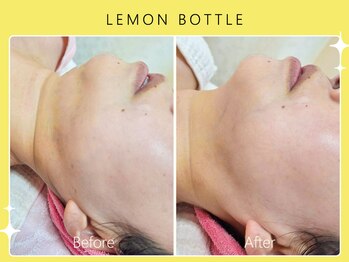 シロカネ 光の森店(SHIROKANE)/レモンボトル☆