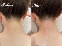 Beauty Salon PIMIL【４/４NEWOPEN（予定）】/うなじ脱毛