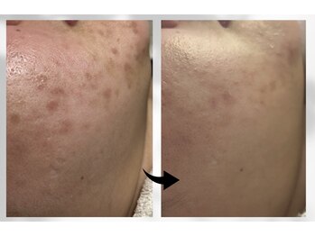 ソラ 菊陽光の森(SOLA+)/ニキビ/跡