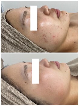 ソフィア わさだ店/30代セルマン肌質改善10回