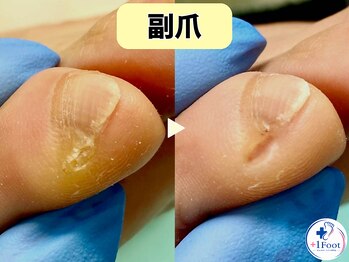 プラスワンフット 本厚木(+1 Foot)/痛い・引っかかる・邪魔な副爪に