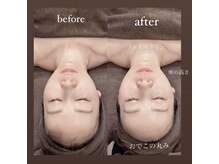 ビューティーサロン シャーロット(Beauty Salon Charlotte)/ハイパーナイフ