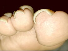 ソラ(sora)/爪の端が内側に巻き込んだ状態!