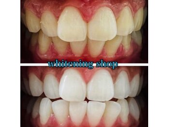 ホワイトニングショップ 長岡京店/ホワイトニングビフォーアフター