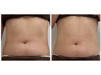 ルミリア(Lumiria)/お腹サイズダウン