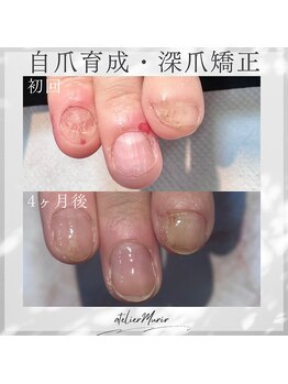 アトリエ ミュリー 代官山(atelier murir)/自爪育成・深爪矯正・巻き爪ケア