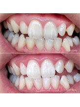 ベル(Belle)/セルフホワイトニング