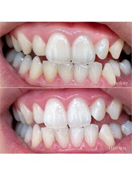 ベル(Belle)/セルフホワイトニング