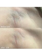 フェイシャルクレア(Cre A.)/脇脱毛1回での変化