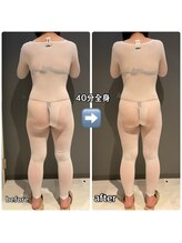 アルバ 広島店(ALBA)/エンダモロジー〈痩身ボディ〉