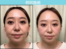 ナチュラルパーフェクトフェイス 新宿/初回施術