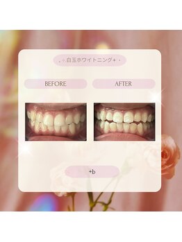 プラスビー 2号店(+b)/ホワイトニングビフォーアフター