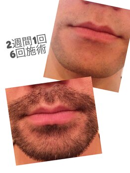 レティティア(Laetitia)/症例3【ヒゲ脱毛】