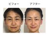 【フェイスライン激変】小顔リフト集中コースお試し初回¥26,000→¥13,000