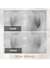 リム ビューティー(RYM BEAUTY)/ダクトピールで苺鼻ツルン
