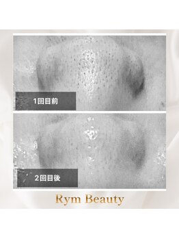 リム ビューティー(RYM BEAUTY)/ダクトピールで苺鼻ツルン