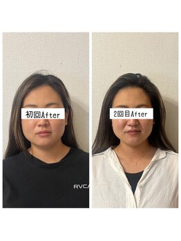 キュープ 奈良店(Qpu)/たった2回でこの変化！