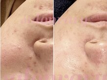 サロンヴェアリー 広尾(salon vary)/水玉リフティング　#ニキビケア