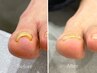 【OPNE記念】巻き爪カウンセリング＋フットネイルケア　9350円→7350円　