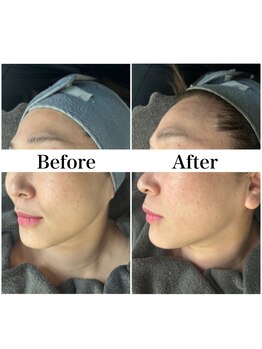 リフェイス(Re:face)/Wピール＋純国産ハーブ