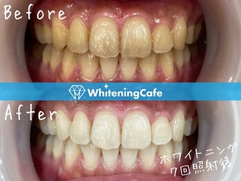 ホワイトニングカフェ 北九州小倉店(WhiteningCafe)