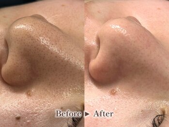 リテルナ(Re.terna)/■毛穴洗浄・毛穴ケアコース