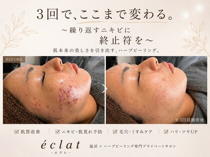 エクレ(eclat)の写真