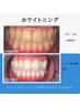 【お得♪】ホワイトニング通い放題シルバーコース月額13,200円で何回でもOK！