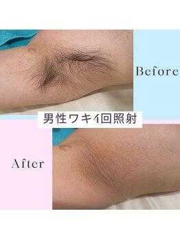 ソテ ボー(Sauter beau)/男性脱毛 ワキ4回施術