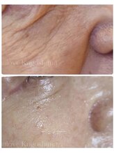 ミーラブ 鹿児島(miilove)/70代シワたるみ改善