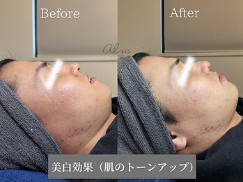 アイシス(AIsis)/【LDM】美白/美肌/肌荒れと乾燥