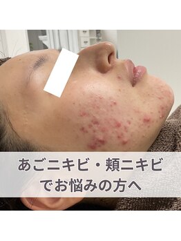 ニキビケア研究所 渋谷店/ほほニキビ・赤ニキビもお任せ！