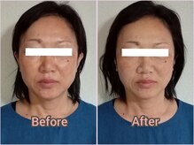 [５０代女性]施術回数１回お顔全体のたるみ／Before-After
