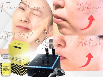 ナイア(naia)の写真/顔ぎゅんっ！で話題の《テラボーラー》×脂肪分解《レモンボトル》で脂肪&たるみ改善、エイジングケアに◎