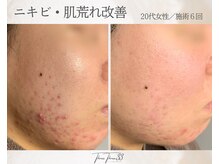 スリースリー 恵比寿(THREE THREE)/ニキビ・肌荒れケア