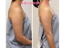 ルマエクレ(rmaecla)の雰囲気（たった6回でこの変化！上半身を薄く）