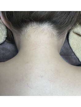 トータルビューティーサロン デザイン/光脱毛うなじ+肩クーポン