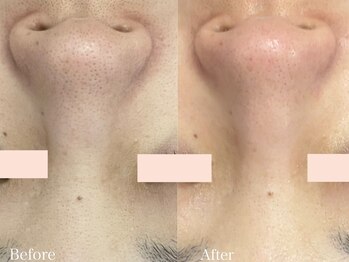ラポーム(La paume)/毛穴洗浄　Before＆After
