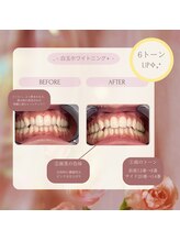 プラスビーセルフ(+b self)/ホワイトニングビフォーアフター