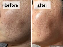 エアル(earu.)/BA|毛穴ケア|ピーリング|高円寺