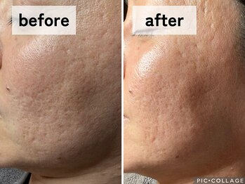 エアル(earu.)/BA|毛穴ケア|ピーリング|高円寺